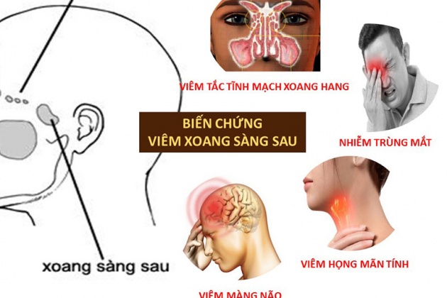 Viêm xoang sàng: Triệu chứng và cách điều trị được chuyên gia khuyên dùng